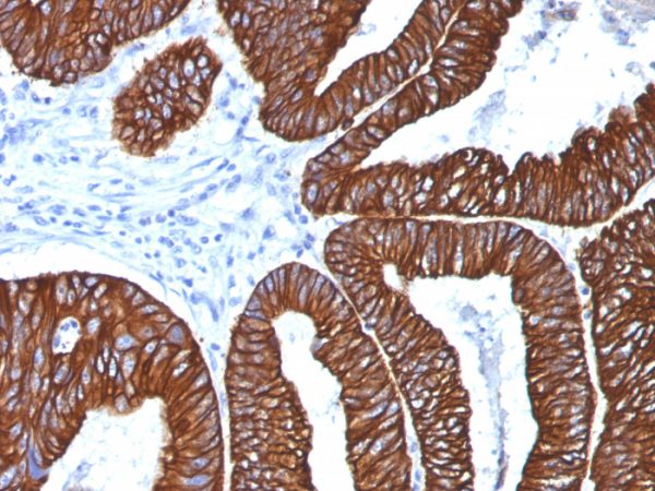 Formalin-fixed, paraffin-embedded human Colon Carcinoma stained with Cytokeratin 8/18 Monoclonal Antibody (5D3).