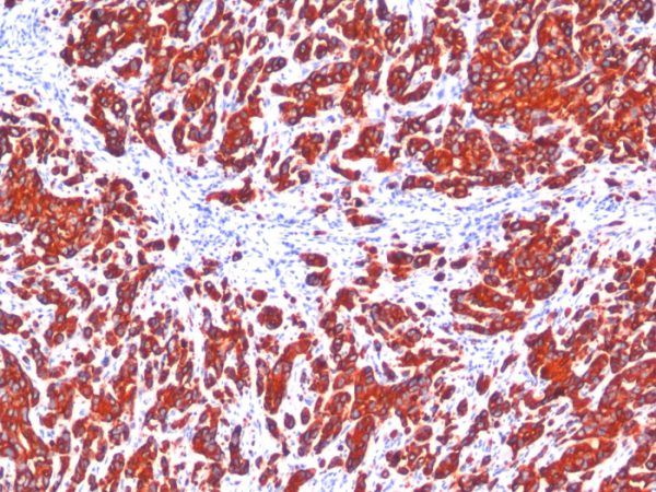 Formalin-fixed, paraffin-embedded human Breast Carcinoma stained with pan Cytokeratin Monoclonal Antibody cocktail (SPM115 + SPM116).