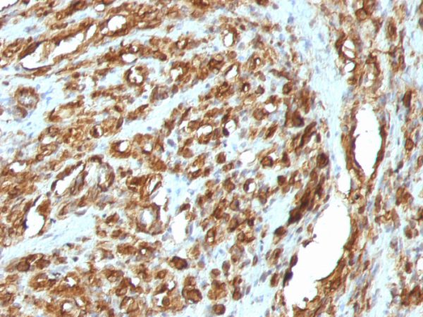 Formalin-fixed, paraffin-embedded human Rhabdomyosarcoma stained with Muscle Specific Actin MAb (HHF35 + MSA/953)