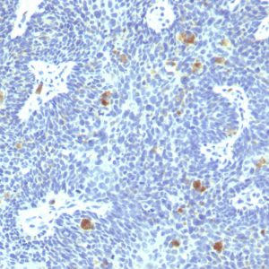 Formalin-fixed, paraffin-embedded human Cervix stained with HPV-16 Mouse Monoclonal Antibody (HPV16/1295).