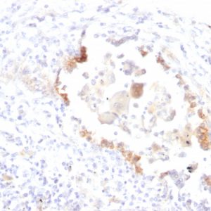 Formalin-fixed, paraffin-embedded human Lung Carcinoma stained with Lewis Y Monoclonal Antibody (LWY/1463).