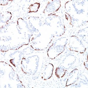 Formalin-fixed, paraffin-embedded human Prostate Carcinoma stained with Cytokeratin, HMW Mouse Monoclonal Antibody (34BE12).