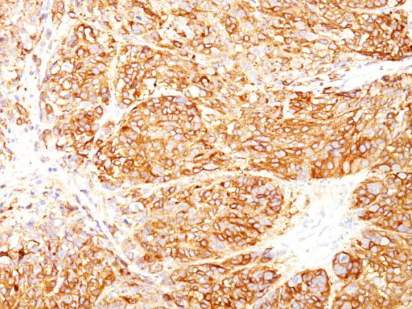 Formalin-fixed, paraffin-embedded human Melanoma stained with Melanoma Marker Mouse Monoclonal Antibody (DT101+ BC199 + HMB45).