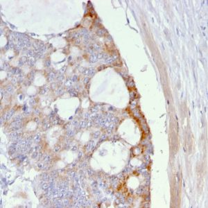 Formalin-fixed, paraffin-embedded human Colon Carcinoma stained with T-F Antigen Mouse Monoclonal Antibody (A63-C/A9).