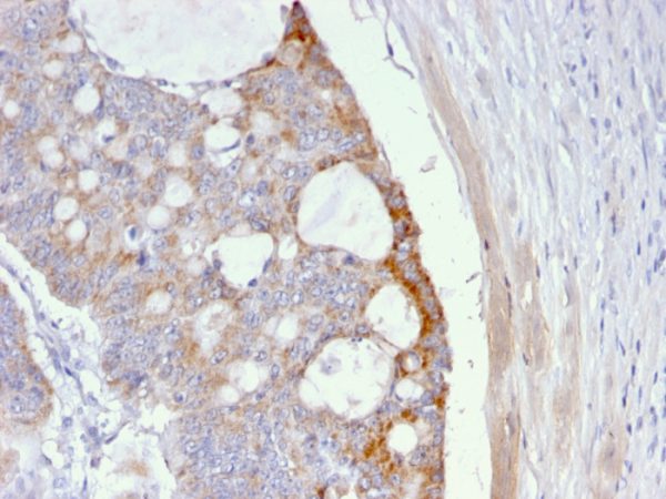 Formalin-fixed, paraffin-embedded human Colon Carcinoma stained with T-F Antigen Mouse Monoclonal Antibody (A63-C/A9).