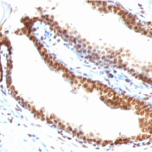 Formalin-fixed, paraffin-embedded human Colon Carcinoma stained with Double Stranded DNA Mouse Monoclonal Antibody (DSD/958)