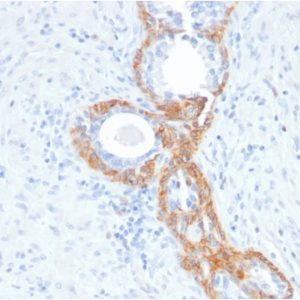 Formalin-fixed, paraffin-embedded human Prostate Carcinoma stained with CK HMW Mouse Recombinant Monoclonal Antibody (rKRTH/2148).