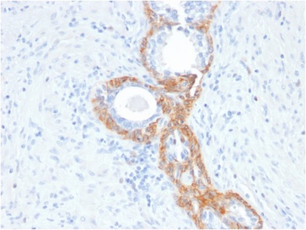 Formalin-fixed, paraffin-embedded human Prostate Carcinoma stained with CK HMW Mouse Recombinant Monoclonal Antibody (rKRTH/2148).
