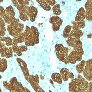 Formalin-fixed, paraffin-embedded human Basal Cell Carcinoma stained with Cytokeratin 5/6 Mouse Monoclonal Antibody (KRT5.6/2438).