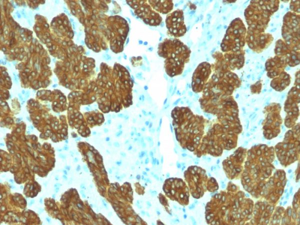 Formalin-fixed, paraffin-embedded human Basal Cell Carcinoma stained with Cytokeratin 5/6 Mouse Monoclonal Antibody (KRT5.6/2438).