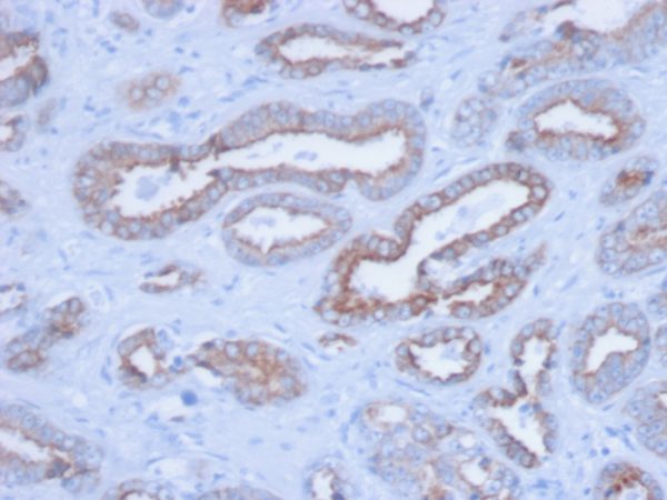 Formalin-fixed, paraffin-embedded human Prostate stained with Pan-Cytokeratin Mouse Monoclonal Antibody (PCK/3150).