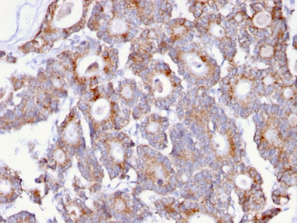 Formalin-fixed, paraffin-embedded human Colon Carcinoma stained with T-F Antigen Mouse Monoclonal Antibody (A84-A/F10).