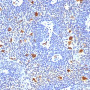 Formalin-fixed, paraffin-embedded human Cervix stained with HPV-16 Mouse Monoclonal Antibody (HPV16/1296).