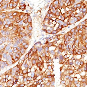 Formalin-fixed, paraffin-embedded human Melanoma stained with Melanoma Marker Mouse Monoclonal (DT101+ BC199 + T311 + HMB45).