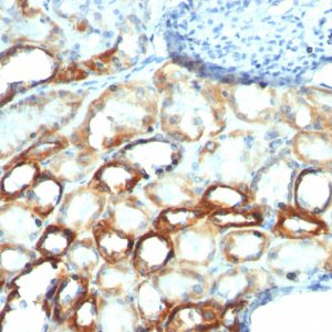 Formalin-fixed, paraffin-embedded human Renal Cell Carcinoma stained with Mitochondria Monoclonal Antibody (MTC754).