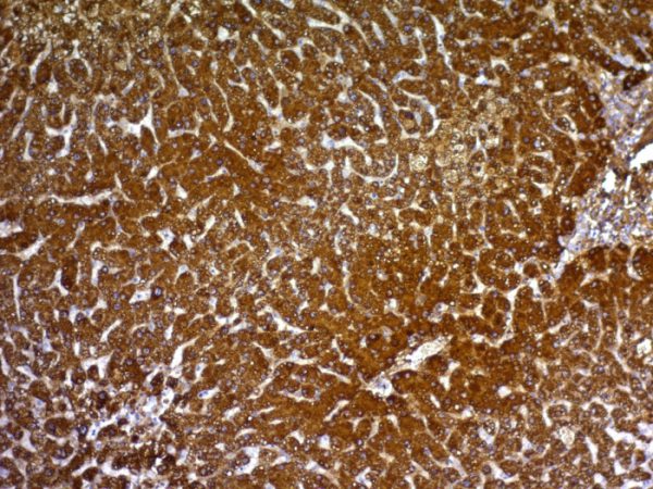 Formalin-fixed, paraffin-embedded human Hepatocellular Carcinoma stained with HepPar-1 Mouse Monoclonal Antibody (HepPar1).