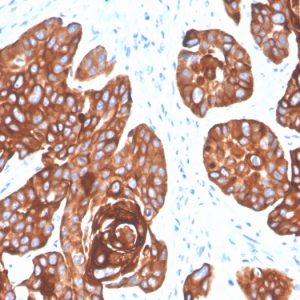 Formalin-fixed, paraffin-embedded human squamous cell carcinoma stained with Cytokeratin 5/6 Mouse Monoclonal Antibody (KRT5.6/4866).