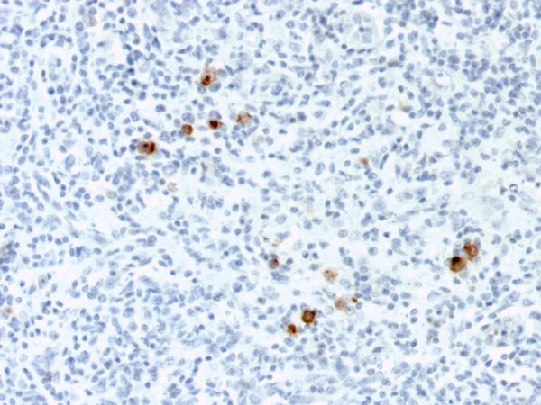 Formalin-fixed, paraffin-embedded human Hodgkin&apos;s Lymphoma stained with EBV Mouse Monoclonal Antibody (CS-4).