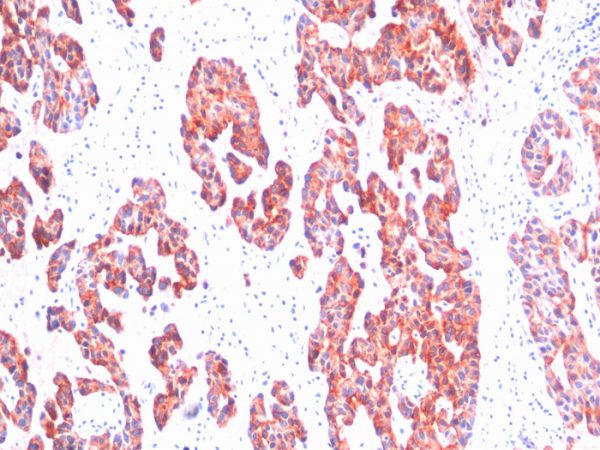 Formalin-paraffin human Breast Carcinoma stained with Cytokeratin, HMW MAb (SPM116).