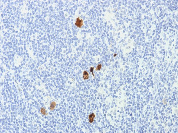 Formalin-fixed, paraffin-embedded human Hodgkin's Lymphoma stained with EBV Mouse Monoclonal Antibody (CS1-4).