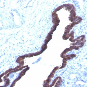Formalin-fixed, paraffin-embedded human Ovarian Cancer stained with Cytokeratin 8/18 Monoclonal Antibody (K8.8 + DC10).