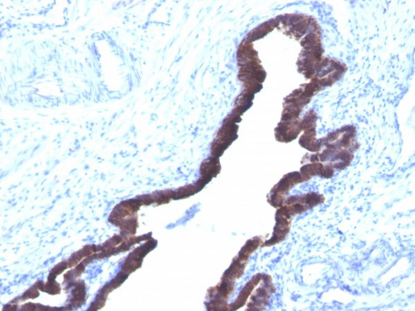Formalin-fixed, paraffin-embedded human Ovarian Cancer stained with Cytokeratin 8/18 Monoclonal Antibody (K8.8 + DC10).