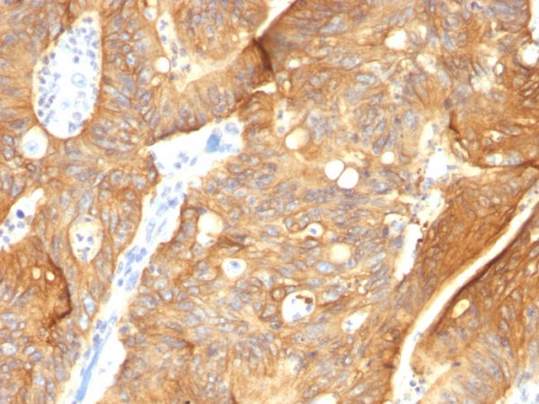 Formalin-fixed, paraffin-embedded human Colon Carcinoma stained with Cytokeratin 8/18 Monoclonal Antibody (K8.8 + DC10).