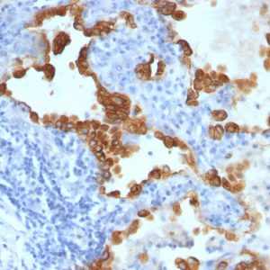 Formalin-fixed, paraffin-embedded human Lung Carcinoma stained with Cytokeratin 8/18 Monoclonal Antibody (SPM192 + SPM265).
