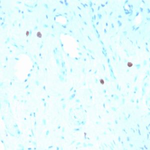 Formalin-fixed, paraffin-embedded human Cervix stained with HPV-16 Mouse Recombinant Monoclonal Antibody (rHPV16L1/1058).