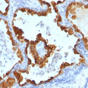 Formalin-fixed, paraffin-embedded human Lung Carcinoma stained with Cytokeratin 8/18 Monoclonal Antibody (C-43 + DC10).