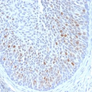 Formalin-fixed, paraffin-embedded human Cervix stained with HPV-18 Mouse Monoclonal Antibody (HPV16 E1/E4).