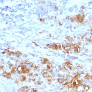 Formalin-fixed, paraffin-embedded human Gastric Carcinoma stained with CA19-9 Rabbit Recombinant Monoclonal Antibody (CA19.9/1390R).