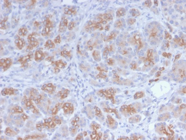 Formalin-fixed, paraffin-embedded human Breast Carcinoma stained with Golgi Rabbit Recombinant Monoclonal Antibody (GLG1/2829R).