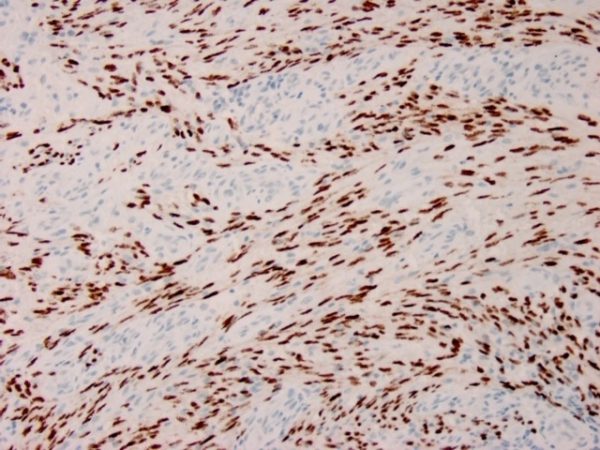 Formalin-fixed, paraffin-embedded human Kaposi&apos;s sarcoma stained with HHV8 Recombinant Rabbit Monoclonal Antibody (HHV8/3633R).