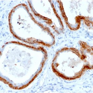 Formalin-fixed, paraffin-embedded human Prostate Carcinoma stained with CK HMW Rabbit Recombinant Monoclonal Antibody (KRTH/2147R).
