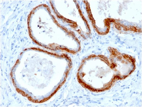 Formalin-fixed, paraffin-embedded human Prostate Carcinoma stained with CK HMW Rabbit Recombinant Monoclonal Antibody (KRTH/2147R).