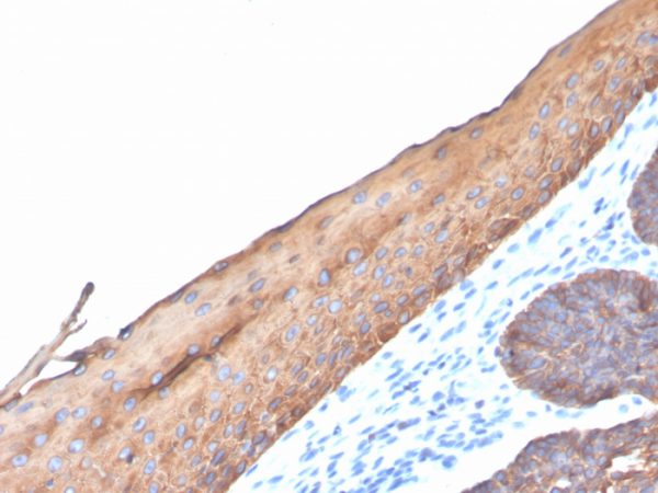 Formalin-fixed, paraffin-embedded human colon carcinoma stained with CK Type I Recombinant Rabbit Monoclonal Antibody (KRTL/4440R).