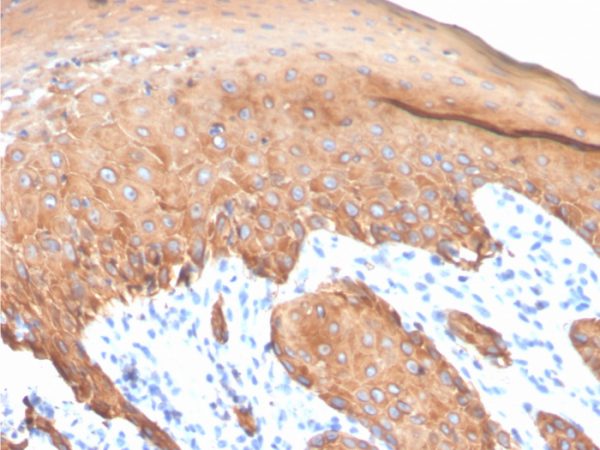 Formalin-fixed, paraffin-embedded human colon carcinoma stained with CK Type I Recombinant Rabbit Monoclonal Antibody (KRTL/4440R).