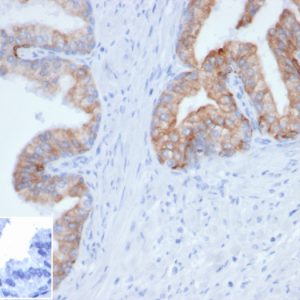 Formalin-fixed, paraffin-embedded human prostate stained with Pan-Cytokeratin Recombinant Rabbit Monoclonal Antibody (PCK/4933R). Inset: PBS instead of primary antibody, secondary control.