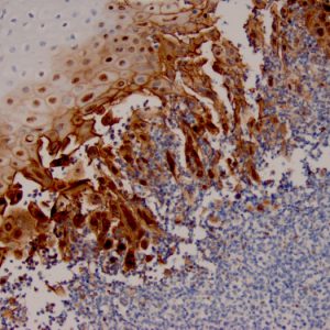 Formalin-fixed, paraffin-embedded human Esophageal Carcinoma stained with HSV1 Recombinant Rabbit Monoclonal Antibody (HSV1/4055R).