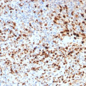 Formalin-fixed, paraffin-embedded human Cervix stained with HSV1 Rabbit Polyclonal Antibody.