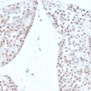 Formalin-fixed, paraffin-embedded human renal oncocytoma stained with SF-1 Recombinant Mouse Monoclonal Antibody (rNR5A1/4369). HIER: Tris/EDTA, pH9.0, 45min. 2°: HRP-polymer, 30min. DAB, 5min.