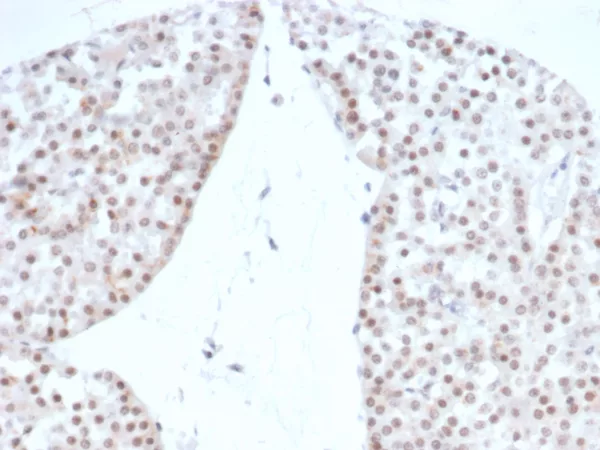 Formalin-fixed, paraffin-embedded human renal oncocytoma stained with SF-1 Recombinant Mouse Monoclonal Antibody (rNR5A1/4369). HIER: Tris/EDTA, pH9.0, 45min. 2°: HRP-polymer, 30min. DAB, 5min.