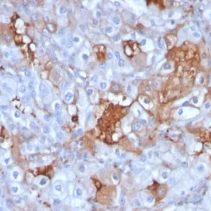 Formalin-fixed, paraffin-embedded human renal cell carcinoma stained with  Cadherin 6 Mouse Monoclonal Antibody (CDH6/3191). HIER: Tris/EDTA, pH9.0, 45min. 2°C: HRP-polymer, 30min. DAB, 5min.