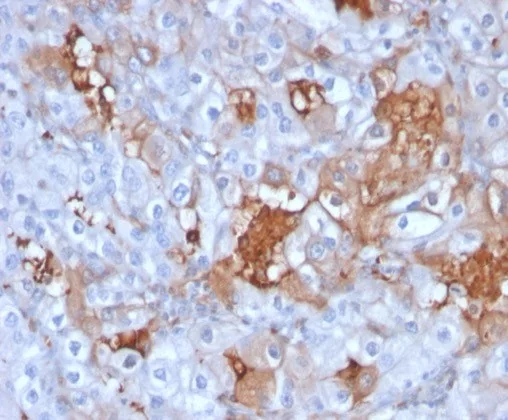 Formalin-fixed, paraffin-embedded human renal cell carcinoma stained with Cadherin 6 Mouse Monoclonal Antibody (CDH6/3191). HIER: Tris/EDTA, pH9.0, 45min. 2°C: HRP-polymer, 30min. DAB, 5min. Cadherin-6 / K-Cadherin Antibody in Immunohistochemistry (IHC (P))