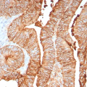 Formalin-fixed, paraffin-embedded human colon stained with CDH17 Recombinant Rabbit Monoclonal Antibody (CDH17/8158R). Inset: PBS instead of primary antibody; secondary only negative control.