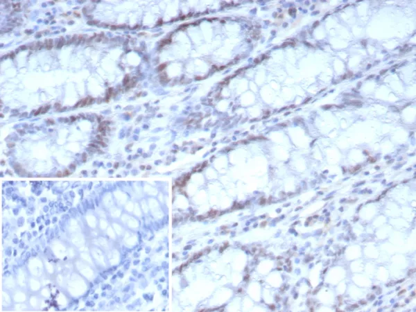 Formalin-fixed, paraffin-embedded human colon carcinoma stained with  CDK4 Mouse Monoclonal Antibody (CDK4/8896). Inset: PBS instead of primary antibody; secondary only negative control.