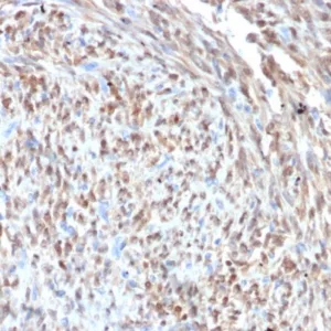 Formalin-fixed, paraffin-embedded human liposarcoma stained with  CDK4 Recombinant Rabbit Monoclonal Antibody (CDK4/7987R). HIER: Tris/EDTA, pH9.0, 45min. 2°C: HRP-polymer, 30min. DAB, 5min.