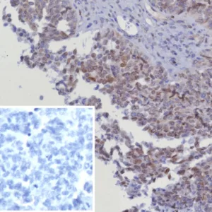 Formalin-fixed, paraffin-embedded human serous ovarian cancer stained with  CDK4 Recombinant Rabbit Monoclonal Antibody (CDK4/8351R). Inset: PBS instead of primary antibody; secondary only negative control.