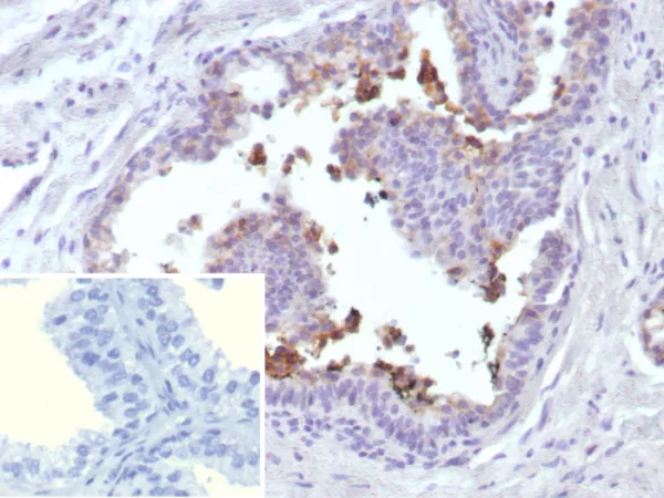 Formalin-fixed, paraffin-embedded human prostate cancer stained with ABCC4 Mouse Monoclonal Antibody (ABCC4/9018). Inset: PBS instead of primary antibody; secondary only negative control.